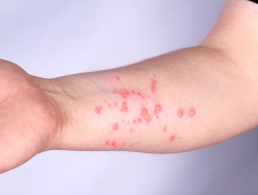 Cachoeiro confirma caso de Mpox e aciona protocolo para evitar disseminação