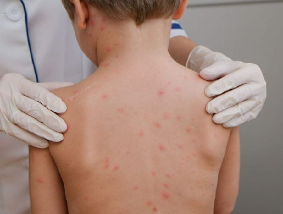 Alerta no ES: meningite já matou 22 pessoas e casos seguem em alta em 2026