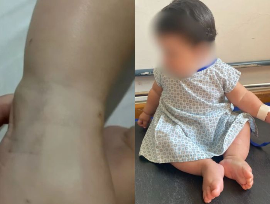 Mãe relata novo drama de bebê queimado em maternidade no ES